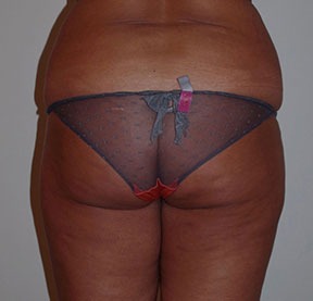 Brazilian Butt Lift Before photo by Dr. Foued Hamza in London