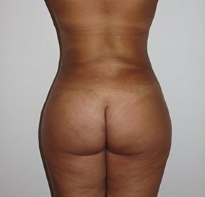 Brazilian Butt Lift After photo by Dr. Foued Hamza in London