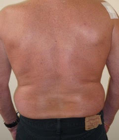 Male Liposuction Before Photo by Dr. Hamza in London