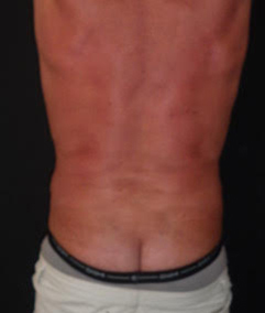 Male Liposuction After Photo by Dr. Hamza in London