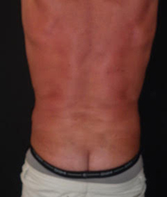 Male Liposuction After photo by Dr. Foued Hamza in London