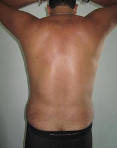 Male Liposuction After photo by Dr. Foued Hamza in London