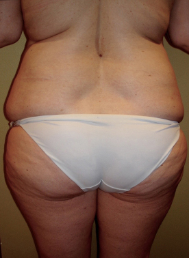 Liposuction Before photo by Dr. Foued Hamza in London