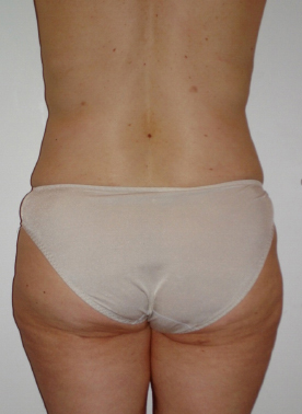 Liposuction After photo by Dr. Foued Hamza in London
