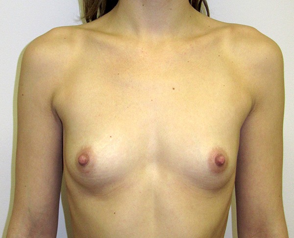 Breast Implants Before photo by Dr. Foued Hamza in London