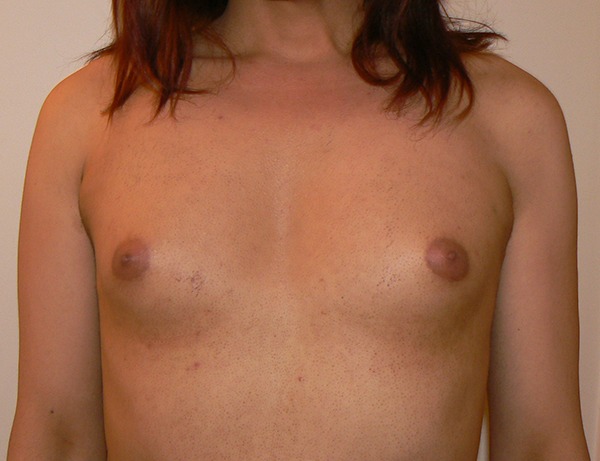 Breast Implants Before photo by Dr. Foued Hamza in London