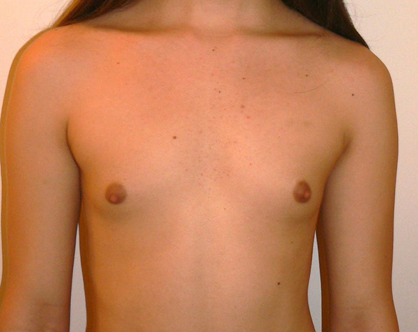 Transgender Breast Augmentation Before photo by Dr. Hamza in London