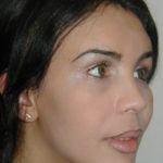Facial Feminization After photo by Dr. Foued Hamza in London