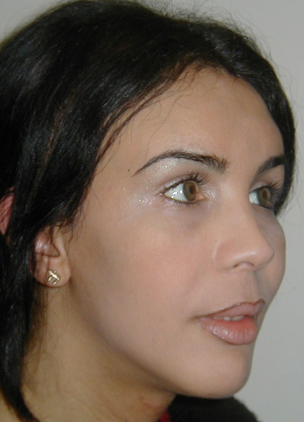 Facial Feminization After photo by Dr. Foued Hamza in London