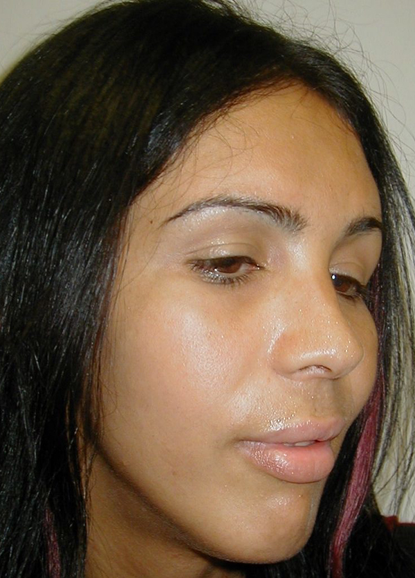 Facial Feminization Before photo by Dr. Foued Hamza in London