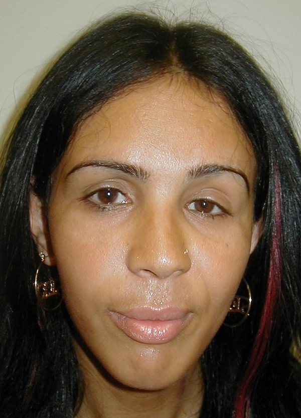 Facial Feminization Before photo by Dr. Foued Hamza in London