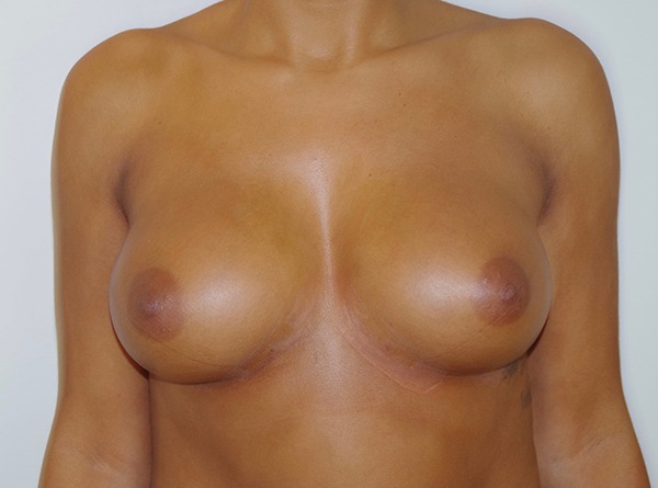 Breast Fat Augmentation After photo by Dr. Foued Hamza in London