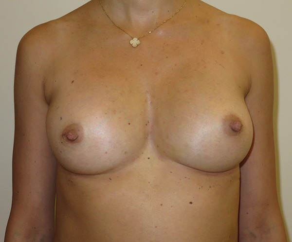 Breast Fat Augmentation After photo by Dr. Foued Hamza in London