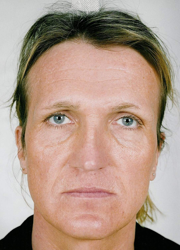 Facial Feminization Before photo by Dr. Foued Hamza in London