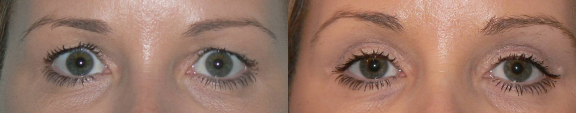 Blepharoplasty before and after photo by Dr. Hamza in London