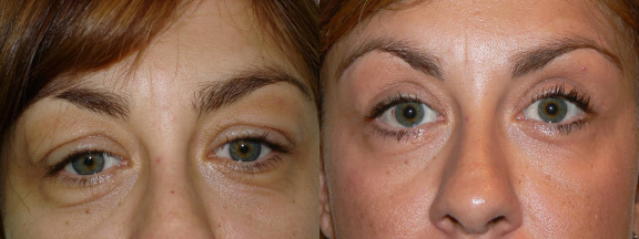 Blepharoplasty before and after photo by Dr. Hamza in London