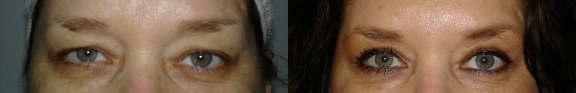 London Blepharoplasty by Dr. Hamza Blepharoplasty before and after photo by Dr. Hamza in London
