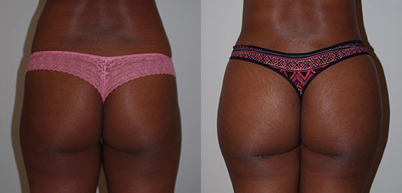 Brazillian Butt Lift Before and After photo by Dr. Foued Hamza in London