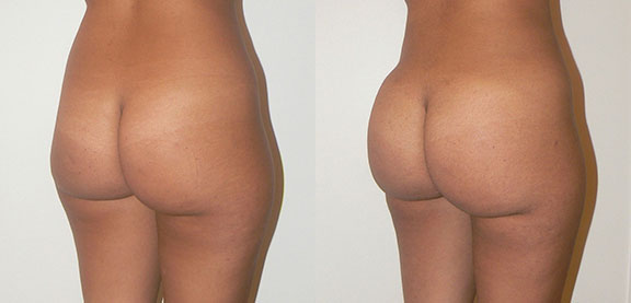Brazillian Butt Lift Before and After photo by Dr. Foued Hamza in London