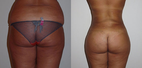 Brazilian Butt Lift Before and After photo by Dr. Foued Hamza in London