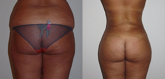 Brazilian Butt Lift Before and After photo by Dr. Foued Hamza in London