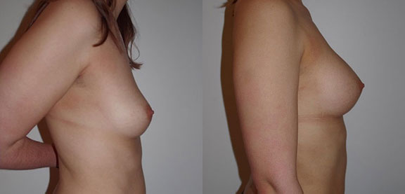 Breast Augmentation with Fat Transfer before and after photo by Dr. Hamza in London