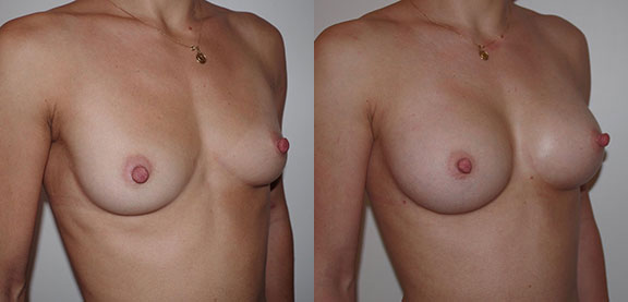 Breast Augmentation with Fat Transfer before and after photo by Dr. Hamza in London