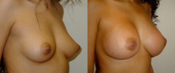 Breast Augmentation Before and After photo by Dr. Hamza in London