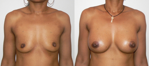 Breast Augmentation Before and After photo by Dr. Hamza in London