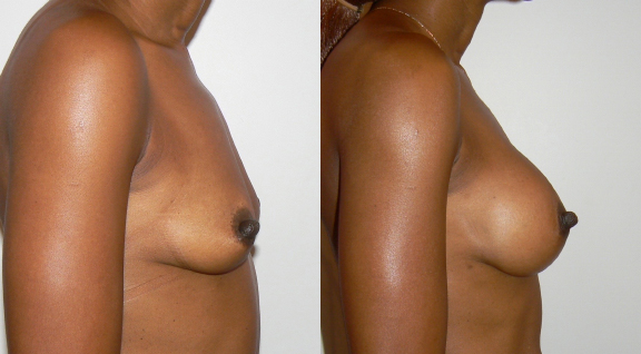Breast Augmentation Before and After photo by Dr. Hamza in London