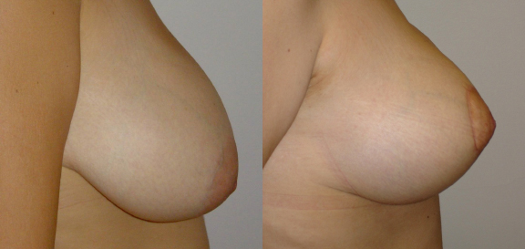 Breast Uplift and Reduction Before and After photo by Dr. Hamza in London