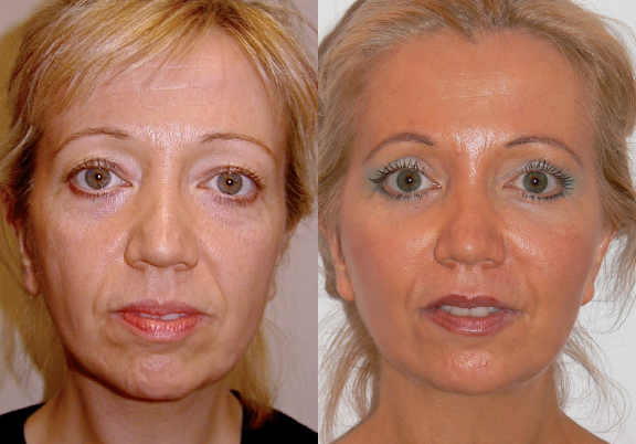 Facelift before and after by Dr. Hamza in London