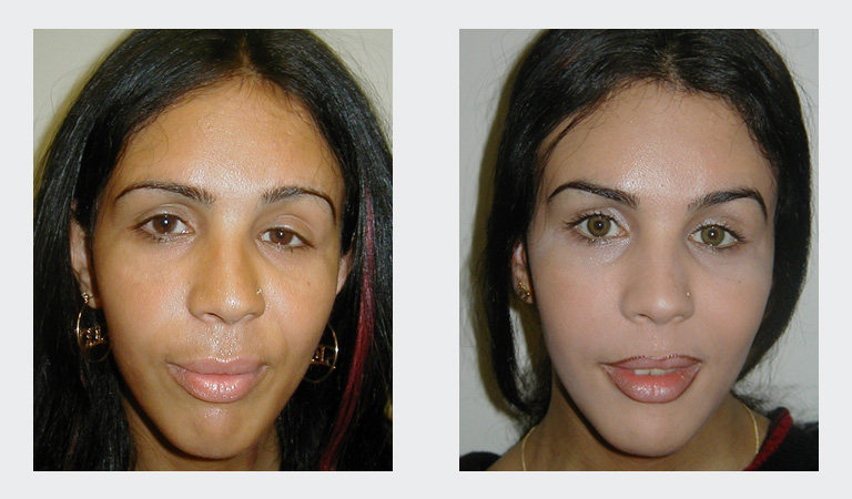 Transgender Surgery before and after photo by Dr. Hamza in London