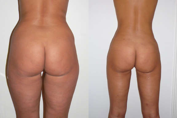 London Liposuction Before And After Photo by Dr. Hamza