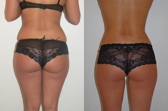 London Liposuction Before And After Photo by Dr. Hamza