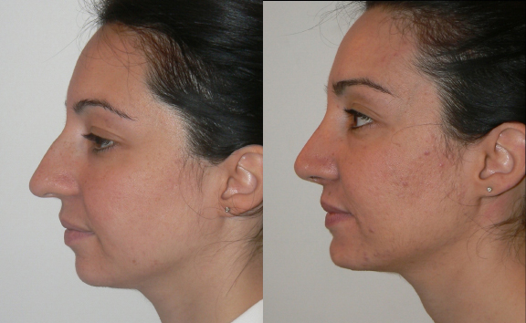 Rhinoplasty before and after photo by Dr. Hamza in London