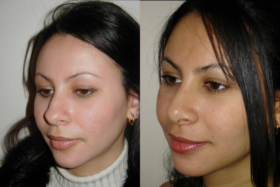 Rhinoplasty before and after photo by Dr. Hamza in London