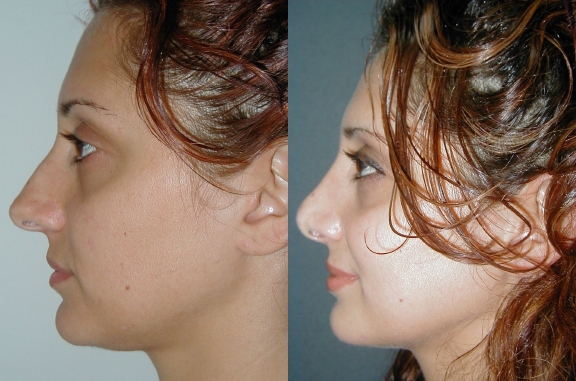 Rhinoplasty before and after photo by Dr. Hamza in London