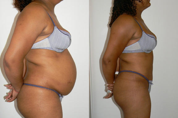 Tummy Tuck before and after photo by Dr. Hamza in London