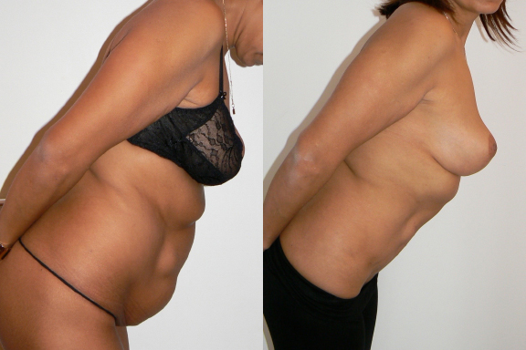 Tummy Tuck before and after photo by Dr. Hamza in London