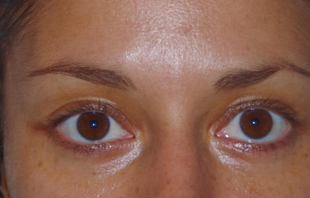 Brow Lift After photo by Dr. Foued Hamza in London