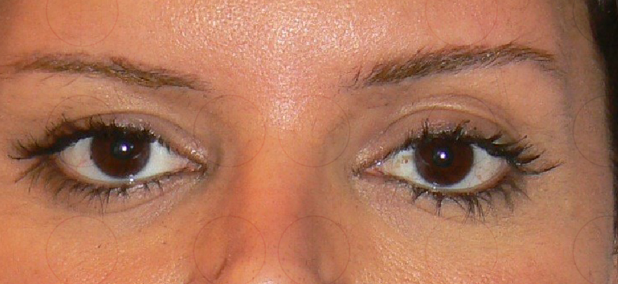 Brow Lift Before photo by Dr. Foued Hamza in London