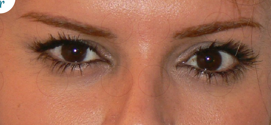 Brow Lift After photo by Dr. Foued Hamza in London