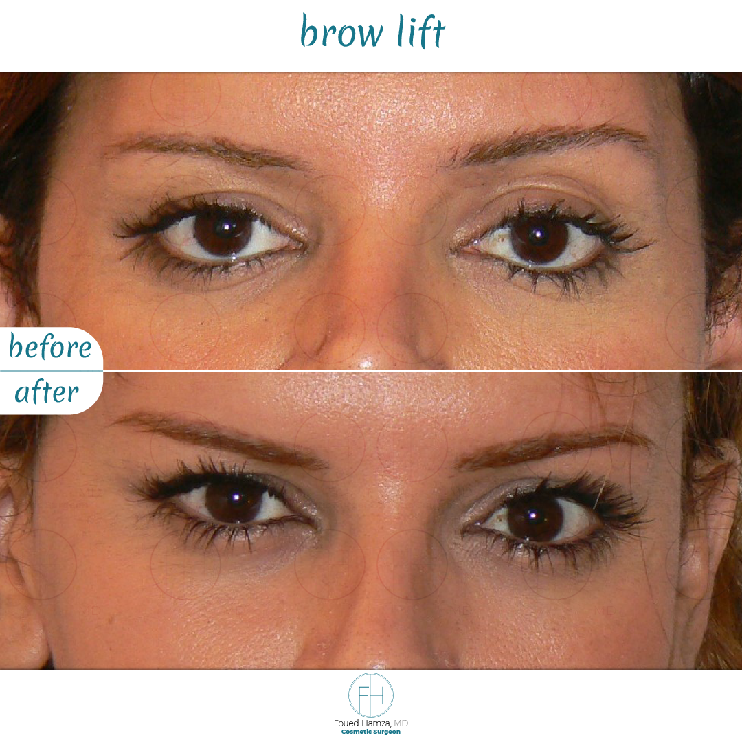 Brow Lift before and after photo by Dr. Hamza in London