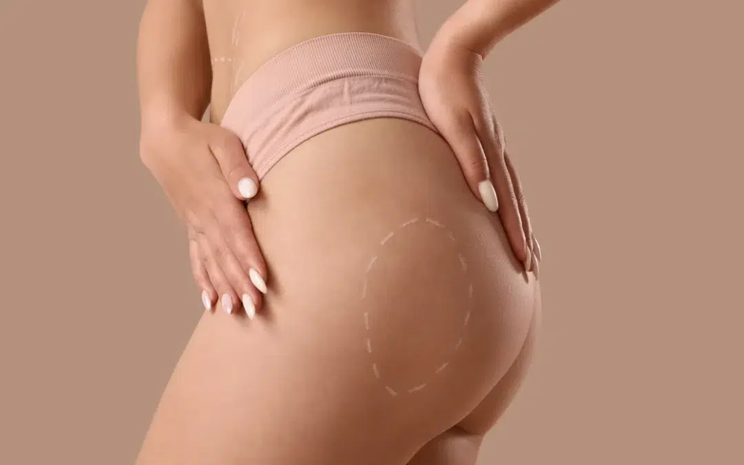 A close-up of a woman's buttocks marked with a line, showcasing the contour from a Brazilian butt lift.