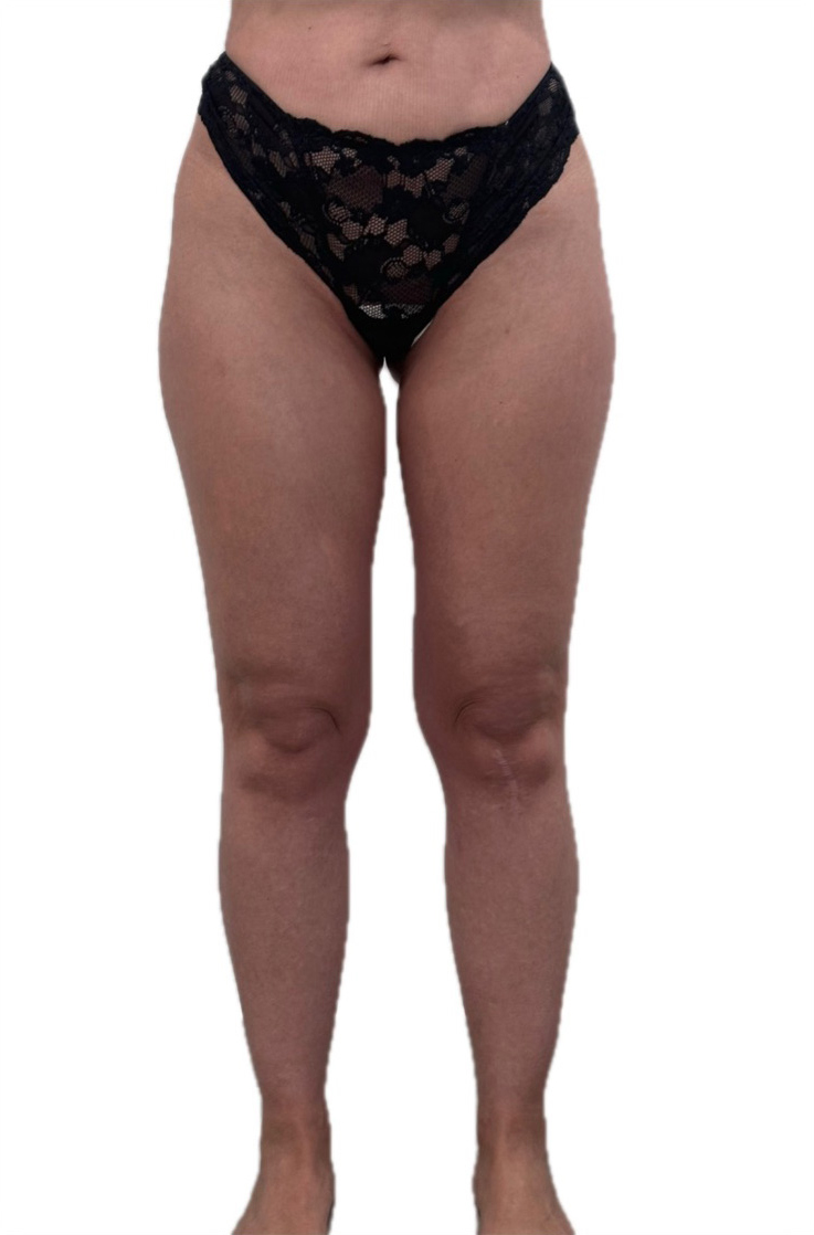 front view before lipedema
