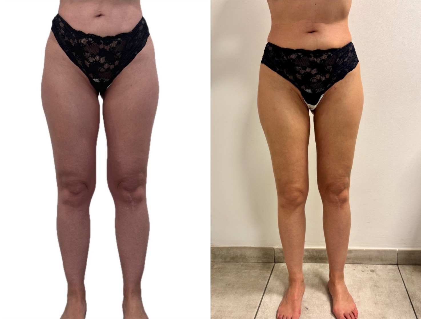 lipedema patient following WAL (Water-Assisted Liposuction) performed by Dr Foued Hamza